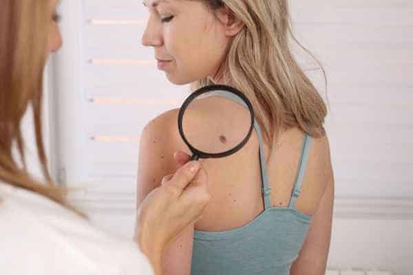 What Are Traditional Skin Lesion Removal Methods uk?