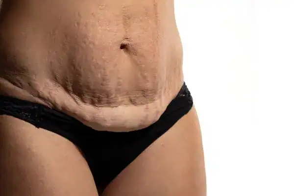 loose skin after weight loss injections uk
