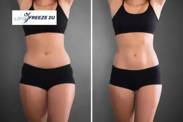 How Can LIPO FREEZE 2U Support Your Post-Pregnancy Body Recovery uk?
