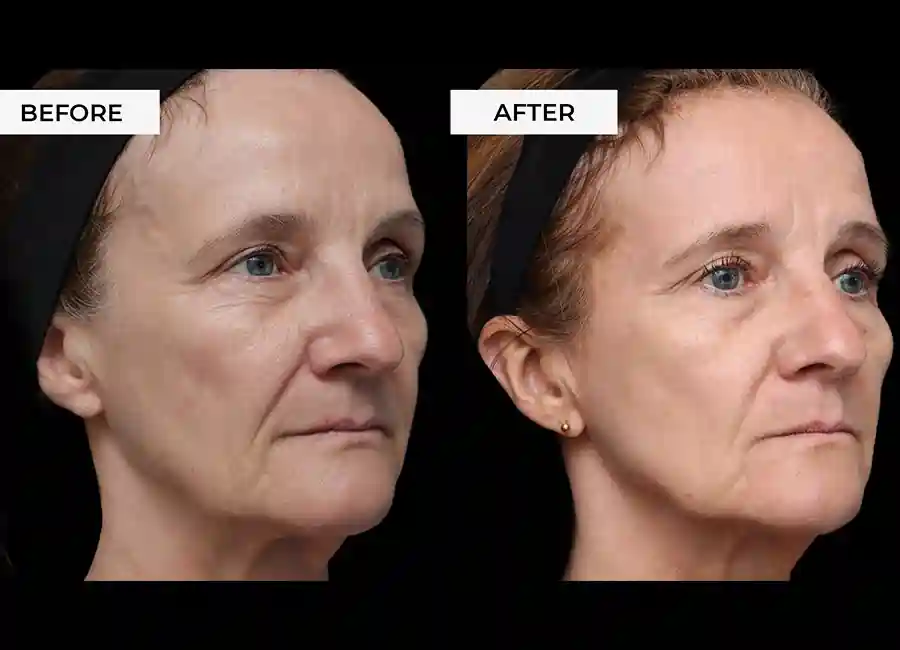 How Many RF Microneedling Sessions Will You Need to See a Difference uk?