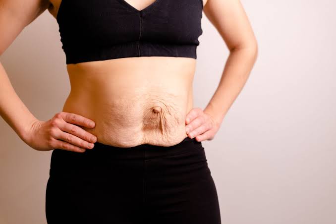 Is Surgery Really the Only Way to Repair Diastasis Recti uk?