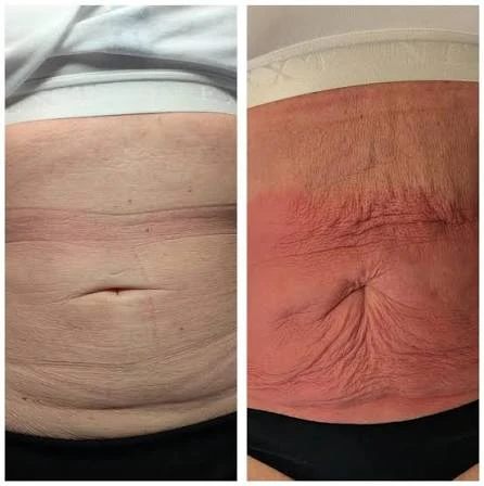 How Does RF Microneedling Improve Crepey, Thin and Uneven Skin Texture uk?