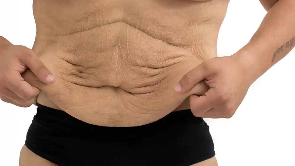 Why Does Weight Loss Medication Leave Some People With Loose or Sagging Skin uk?